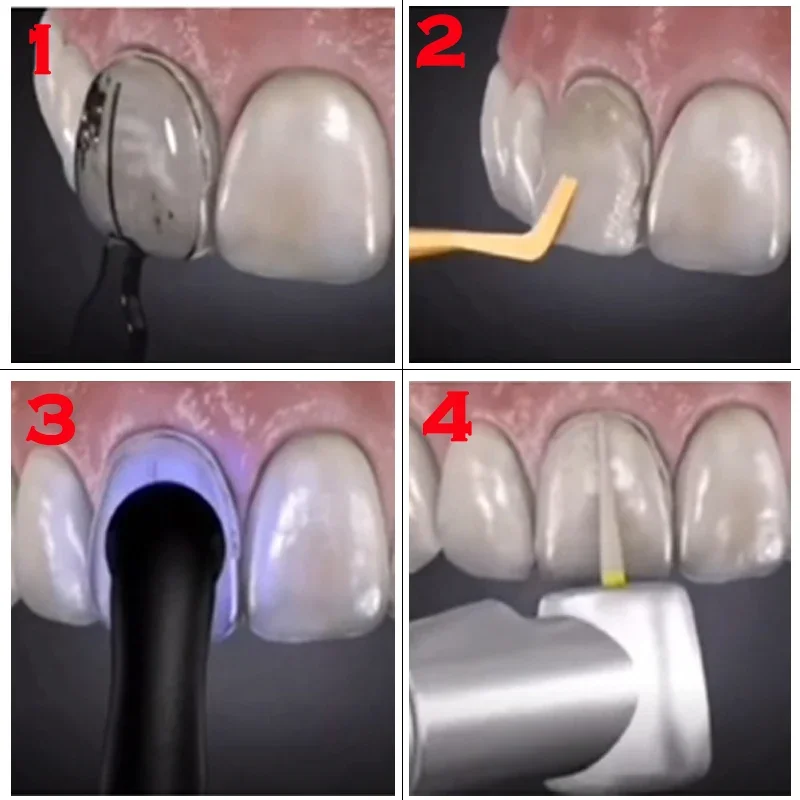 Zahnformen für Komposit-Veneer – Teeth Whitening Moulds Bewertung und Preis