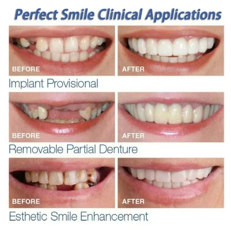 Snap-on-Furnier-Zahnsatz, vers – Teeth Whitening Kit Bewertung und Preis